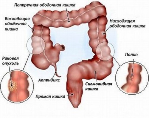 Очищення кишечника фортрансом. Суть методу, результати, думки