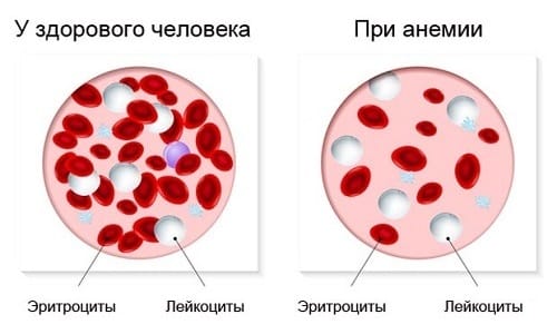 Симптоми та лікування анемії при геморої