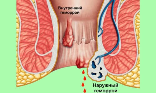 Як харчуватися при геморої з кровотечею?