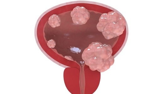Після прийому антибіотиків цистит не проходить