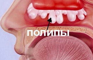 Поліпи в носі – симптоми хвороби, профілактика і лікування Поліпів у носі, причини захворювання і його діагностика на EUROLAB