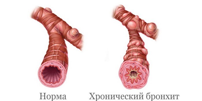 Ускладнення після бронхіту у дорослих на серце –