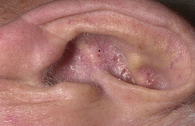 Вушної дерматит у людей і лікування вушної раковини