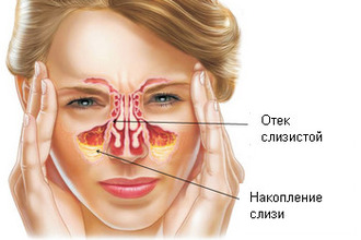 Як лікувати синусит в домашніх умовах швидко у дорослого