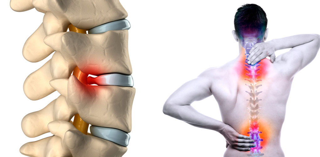 Лікування грижі міжхребцевого диска в санаторії